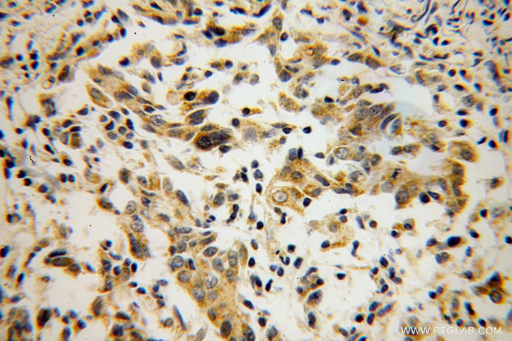 Immunohistochemistry (IHC) staining of human breast cancer tissue using SDHC Polyclonal antibody (14575-1-AP)