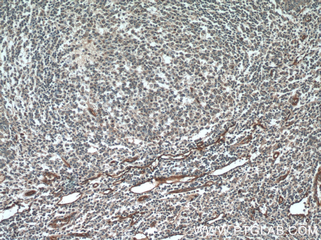 Immunohistochemistry (IHC) staining of human tonsillitis tissue using SDPR Polyclonal antibody (12339-1-AP)