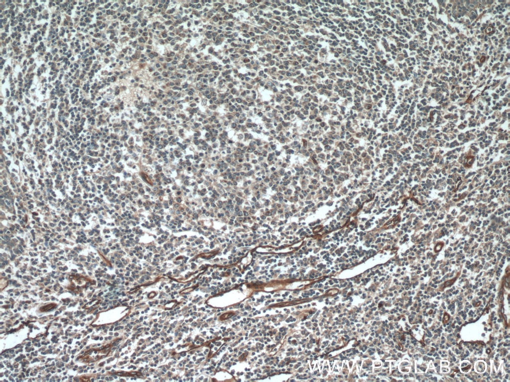 IHC staining of human tonsillitis using 12339-1-AP