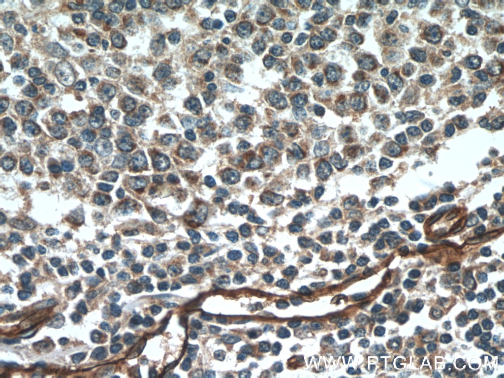 Immunohistochemistry (IHC) staining of human tonsillitis tissue using SDPR Polyclonal antibody (12339-1-AP)