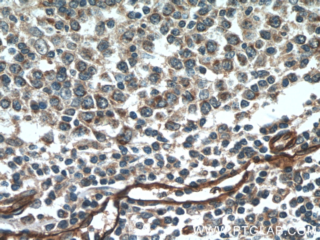 IHC staining of human tonsillitis using 12339-1-AP