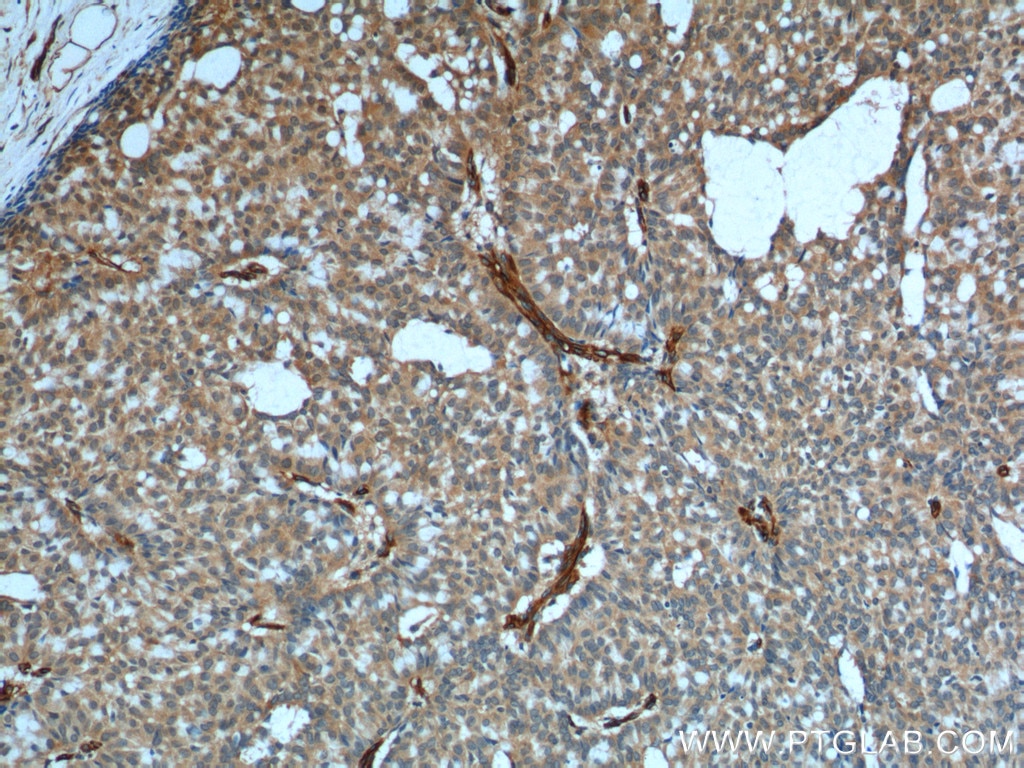 Immunohistochemistry (IHC) staining of human breast hyperplasia tissue using SDPR Polyclonal antibody (12339-1-AP)