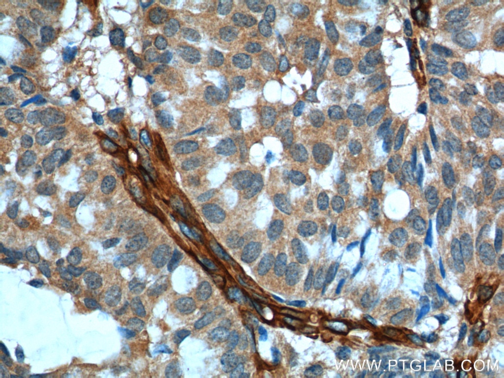 Immunohistochemistry (IHC) staining of human breast hyperplasia tissue using SDPR Polyclonal antibody (12339-1-AP)