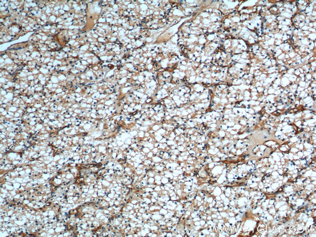 Immunohistochemistry (IHC) staining of human renal cell carcinoma tissue using SDPR Polyclonal antibody (12339-1-AP)