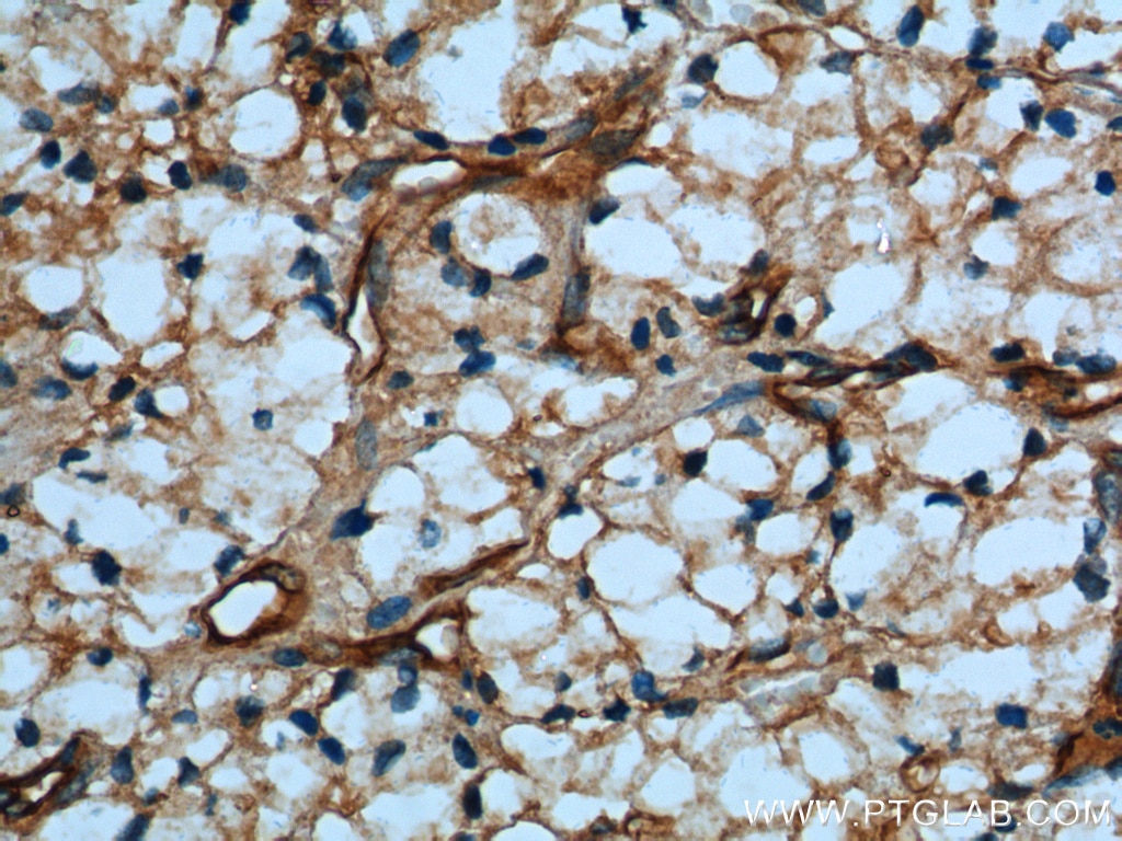 IHC staining of human renal cell carcinoma using 12339-1-AP