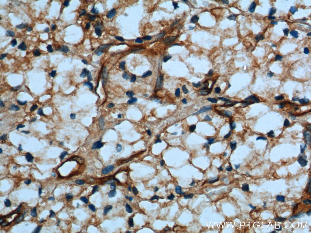 Immunohistochemistry (IHC) staining of human renal cell carcinoma tissue using SDPR Polyclonal antibody (12339-1-AP)