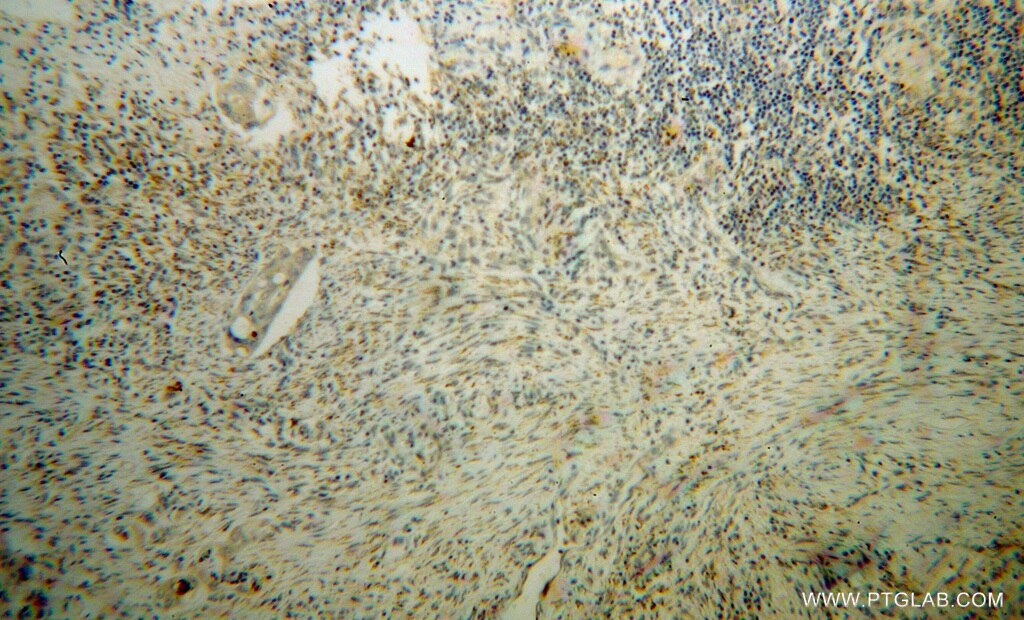 Immunohistochemistry (IHC) staining of human colon cancer tissue using SEC11A Polyclonal antibody (14753-1-AP)