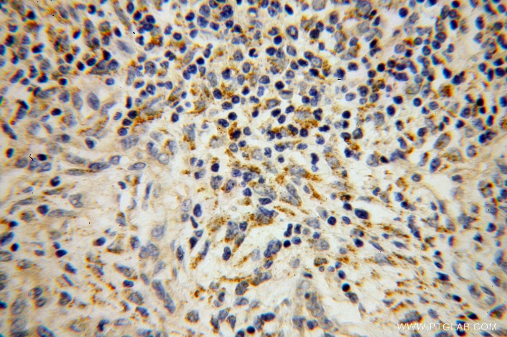 Immunohistochemistry (IHC) staining of human colon cancer tissue using SEC11A Polyclonal antibody (14753-1-AP)