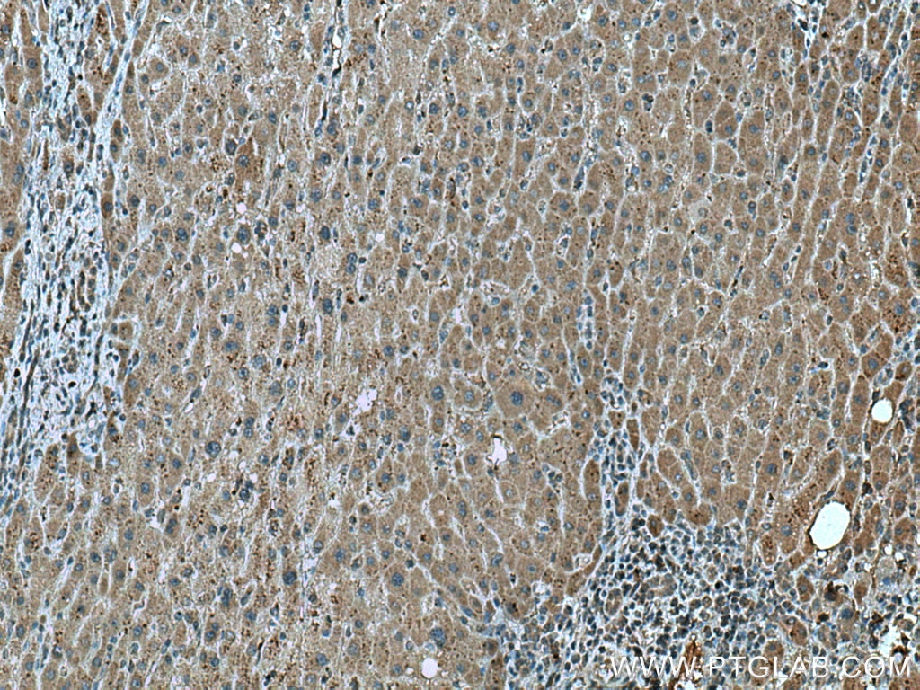 Immunohistochemistry (IHC) staining of human liver cancer tissue using SEC11A Monoclonal antibody (67379-1-Ig)