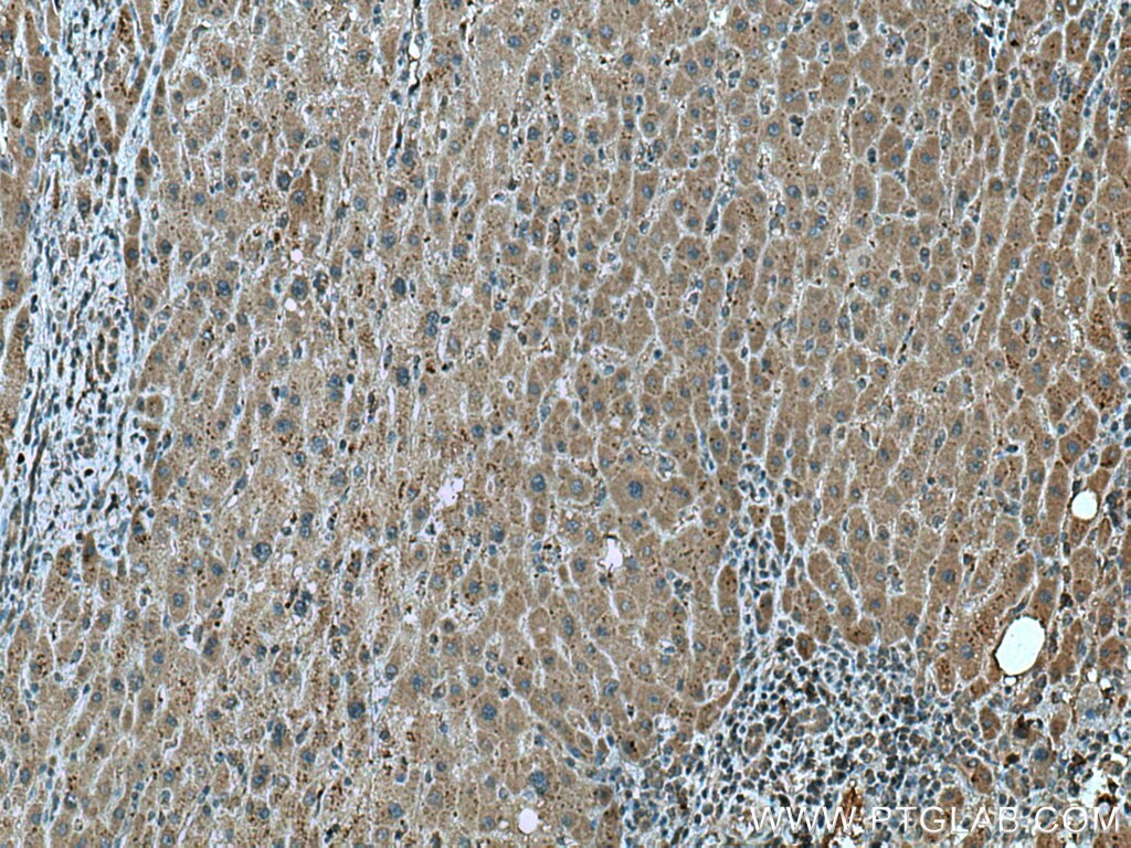 IHC staining of human liver cancer using 67379-1-Ig