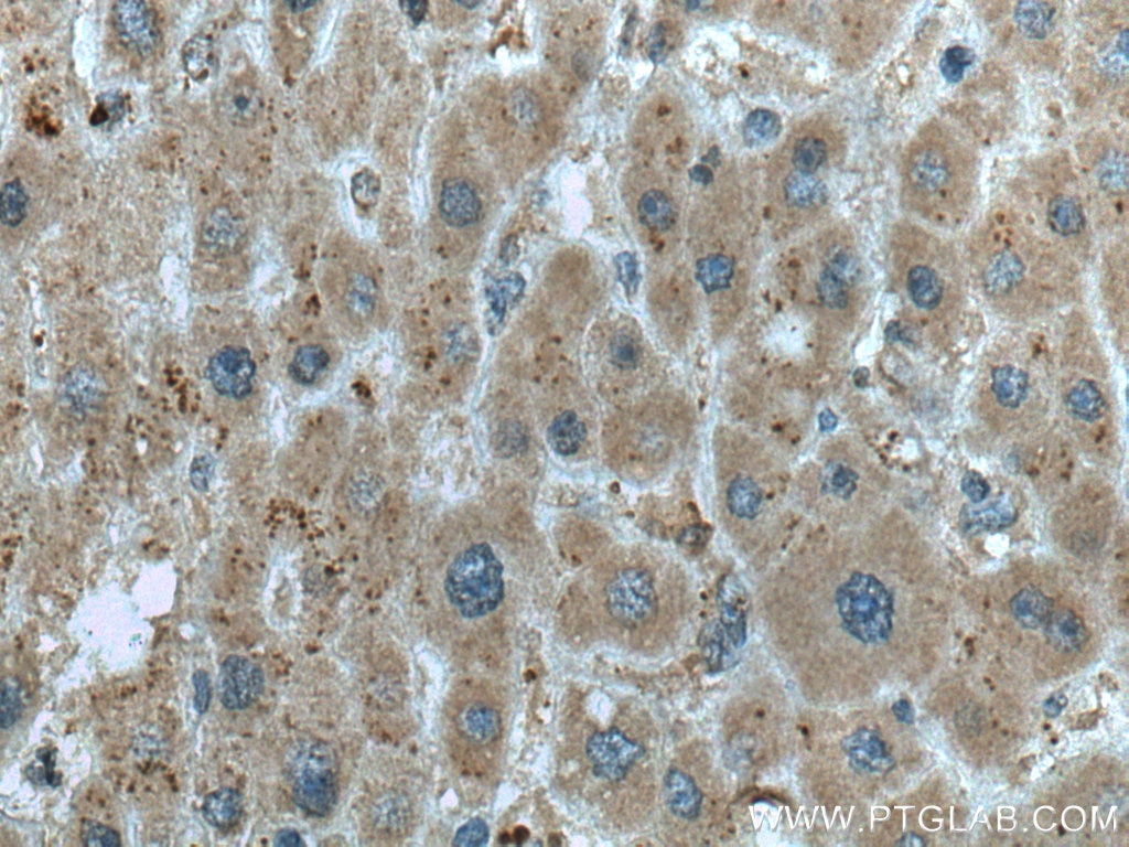 Immunohistochemistry (IHC) staining of human liver cancer tissue using SEC11A Monoclonal antibody (67379-1-Ig)