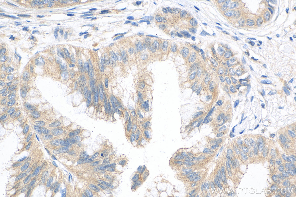 Immunohistochemistry (IHC) staining of human pancreas cancer tissue using SEC16B Polyclonal antibody (17245-1-AP)
