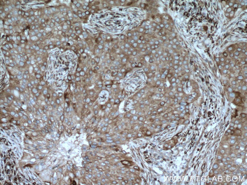 IHC staining of human breast cancer using 14776-1-AP