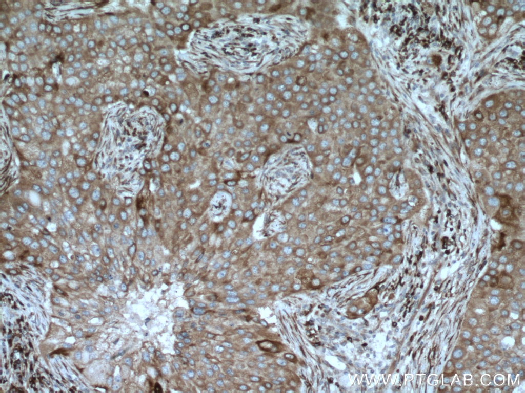 Immunohistochemistry (IHC) staining of human breast cancer tissue using SEC22B Polyclonal antibody (14776-1-AP)