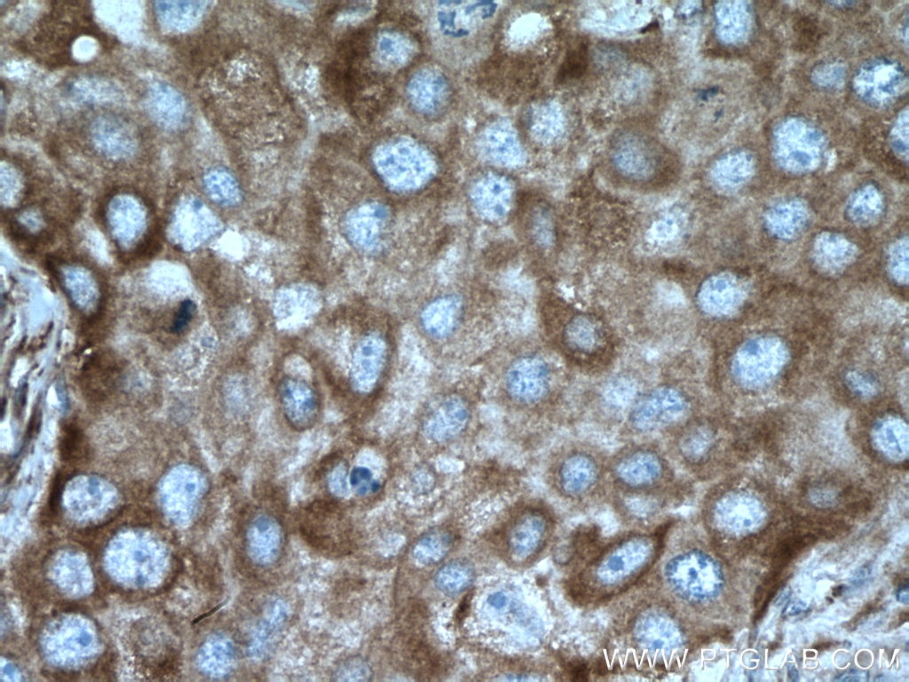 Immunohistochemistry (IHC) staining of human breast cancer tissue using SEC22B Polyclonal antibody (14776-1-AP)