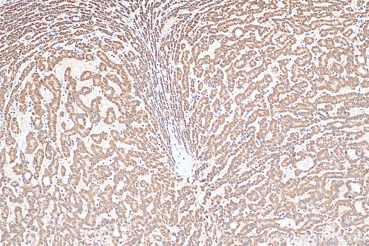 Immunohistochemistry (IHC) staining of human liver cancer tissue using SEC22C Polyclonal antibody (28078-1-AP)