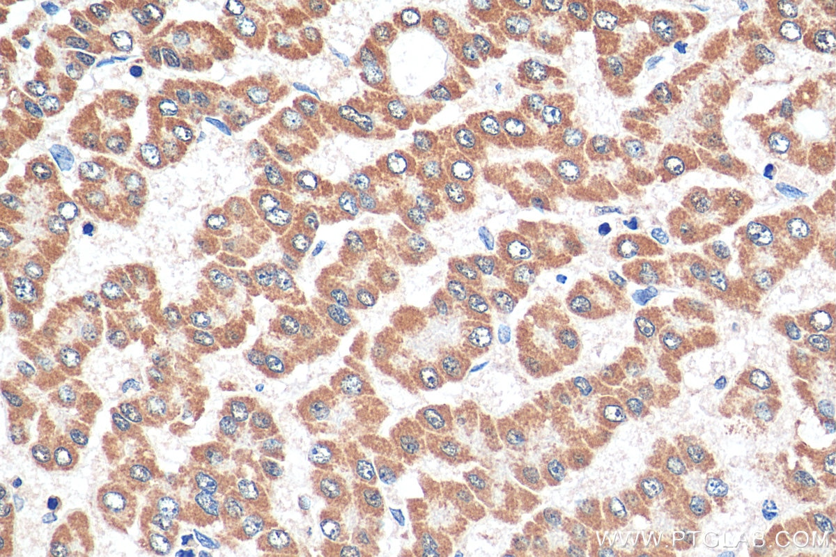 Immunohistochemistry (IHC) staining of human liver cancer tissue using SEC22C Polyclonal antibody (28078-1-AP)