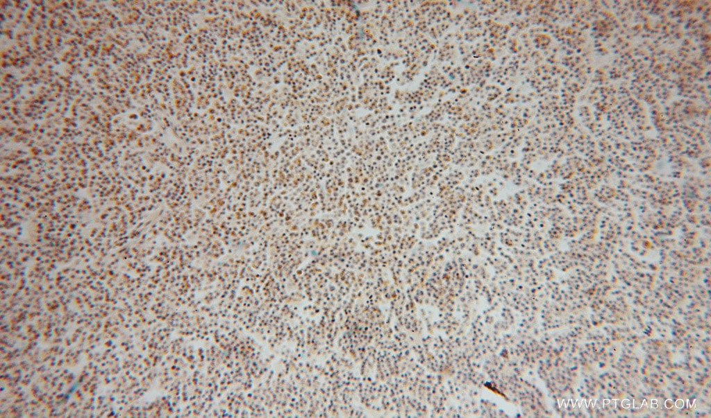 Immunohistochemistry (IHC) staining of human lymphoma tissue using SEC24A Polyclonal antibody (15958-1-AP)