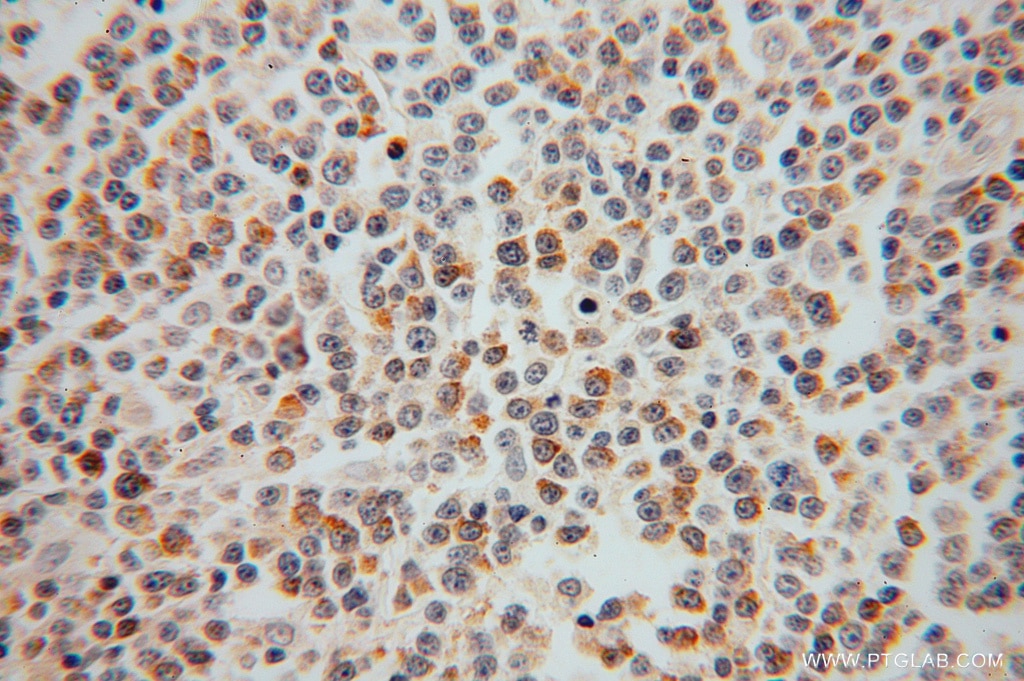 Immunohistochemistry (IHC) staining of human lymphoma tissue using SEC24A Polyclonal antibody (15958-1-AP)