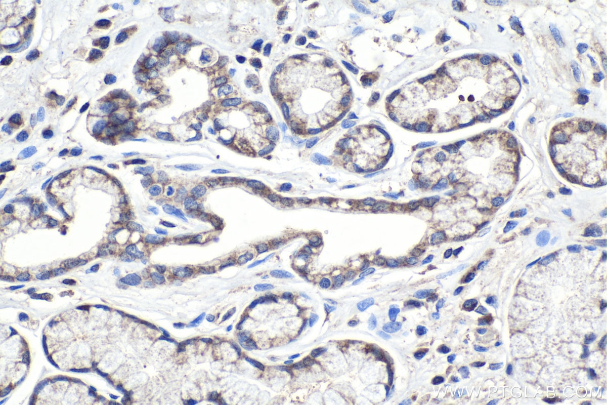 Immunohistochemistry (IHC) staining of human stomach cancer tissue using SEC24C Polyclonal antibody (16073-1-AP)