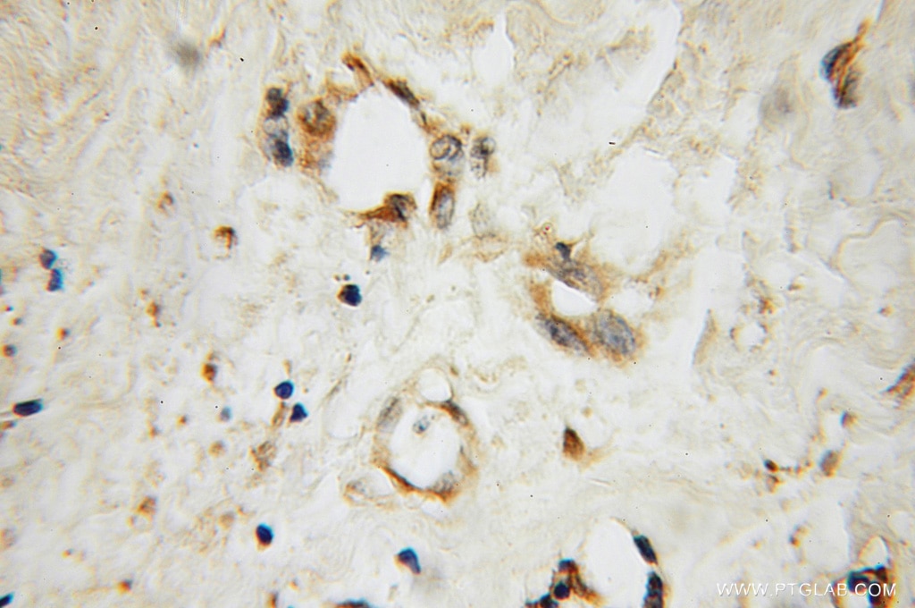 Immunohistochemistry (IHC) staining of human breast cancer tissue using SEC5/EXOC2 Polyclonal antibody (12751-1-AP)