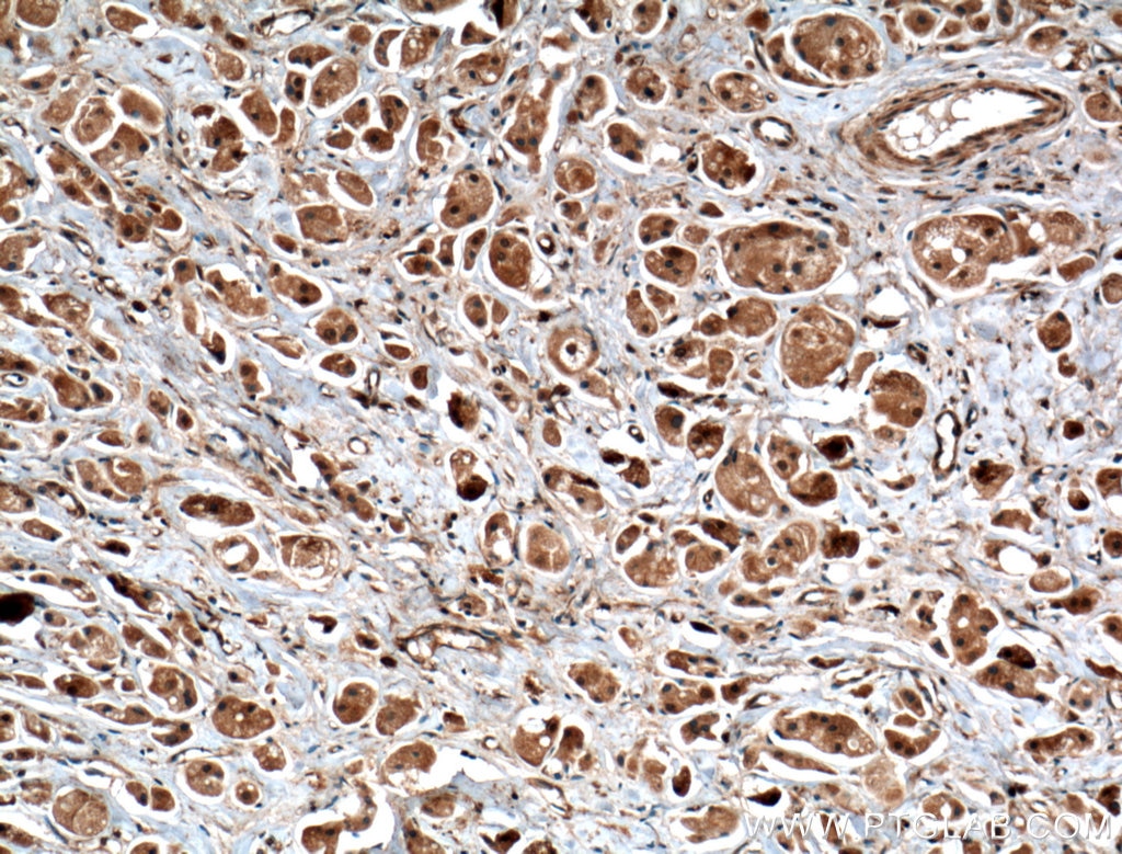 Immunohistochemistry (IHC) staining of human breast cancer tissue using SEC5/EXOC2 Monoclonal antibody (66011-1-Ig)