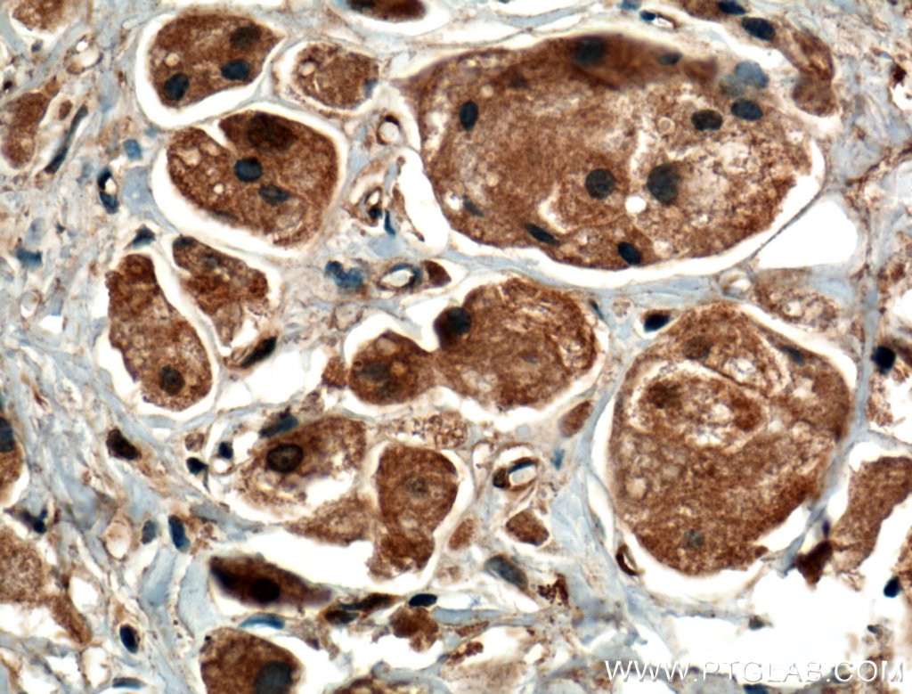 Immunohistochemistry (IHC) staining of human breast cancer tissue using SEC5/EXOC2 Monoclonal antibody (66011-1-Ig)
