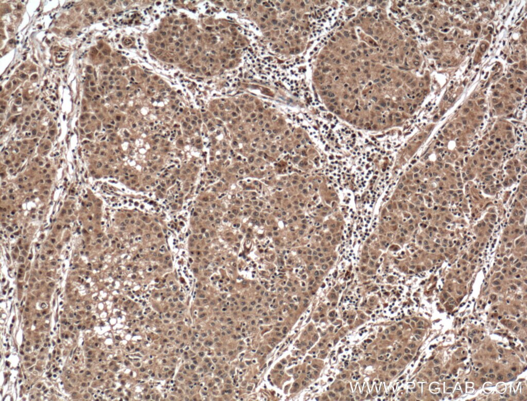 Immunohistochemistry (IHC) staining of human liver cancer tissue using SEC5/EXOC2 Monoclonal antibody (66011-1-Ig)