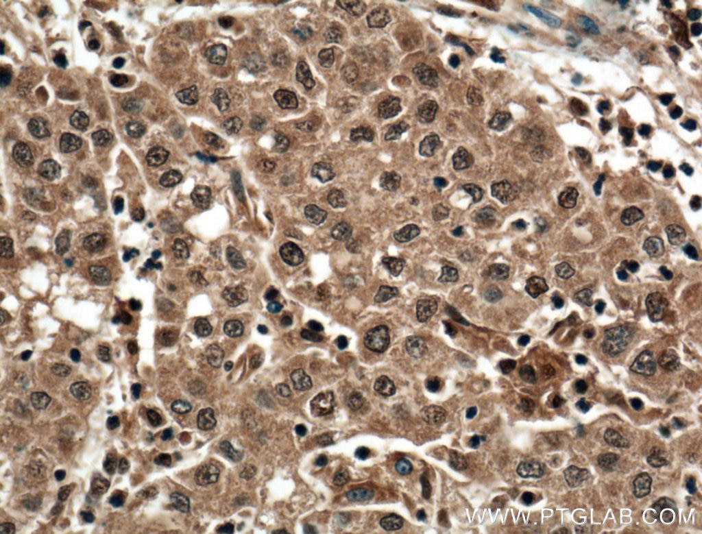 Immunohistochemistry (IHC) staining of human liver cancer tissue using SEC5/EXOC2 Monoclonal antibody (66011-1-Ig)