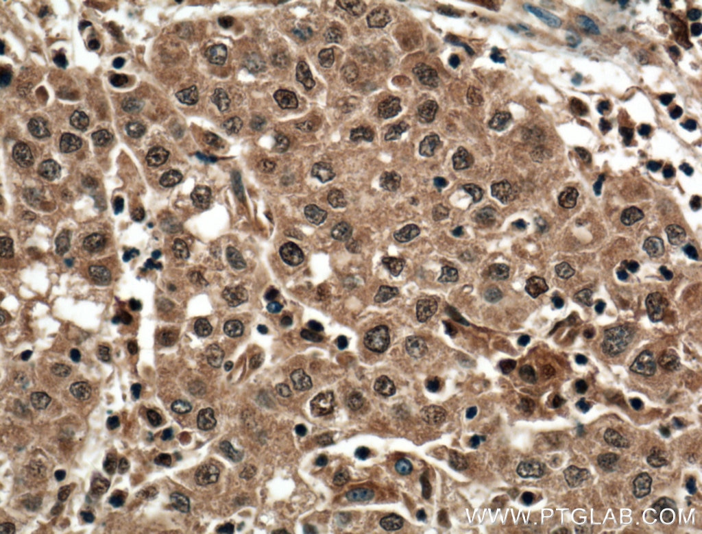 IHC staining of human liver cancer using 66011-1-Ig