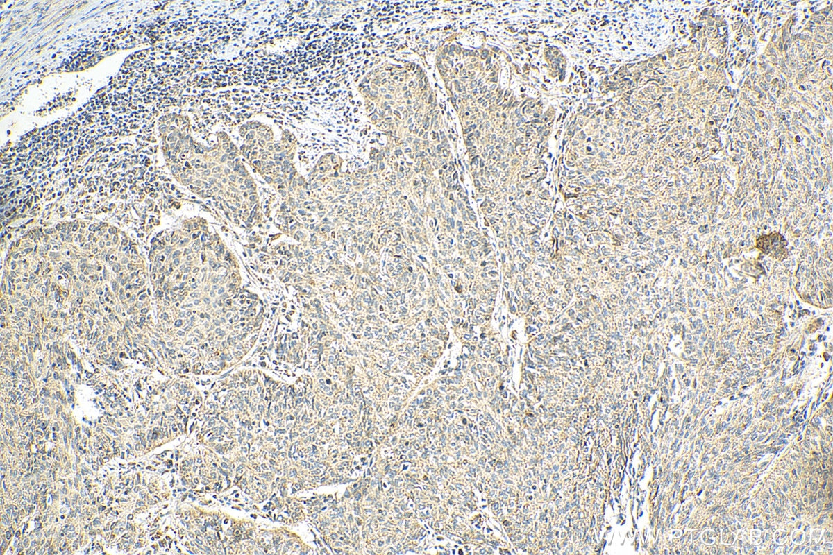 Immunohistochemistry (IHC) staining of human cervical cancer tissue using SEC61B Polyclonal antibody (15087-1-AP)