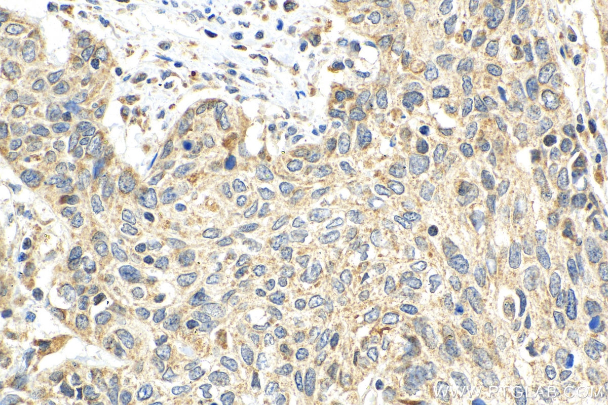 Immunohistochemistry (IHC) staining of human cervical cancer tissue using SEC61B Polyclonal antibody (15087-1-AP)