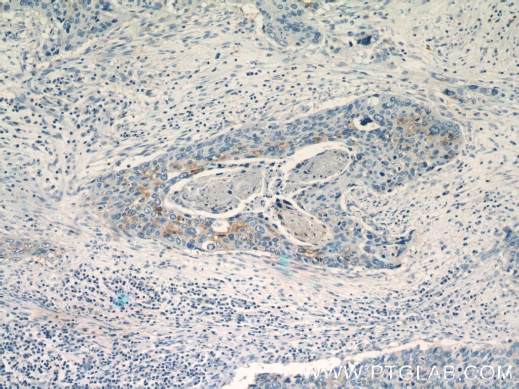 Immunohistochemistry (IHC) staining of human cervical cancer tissue using SEC61B-Specific Polyclonal antibody (14846-1-AP)