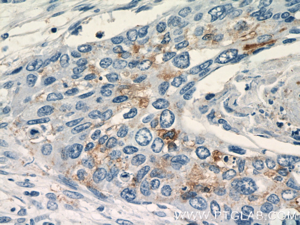 Immunohistochemistry (IHC) staining of human cervical cancer tissue using SEC61B-Specific Polyclonal antibody (14846-1-AP)