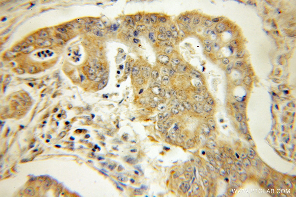 Immunohistochemistry (IHC) staining of human colon cancer tissue using SEC61G Polyclonal antibody (11147-2-AP)