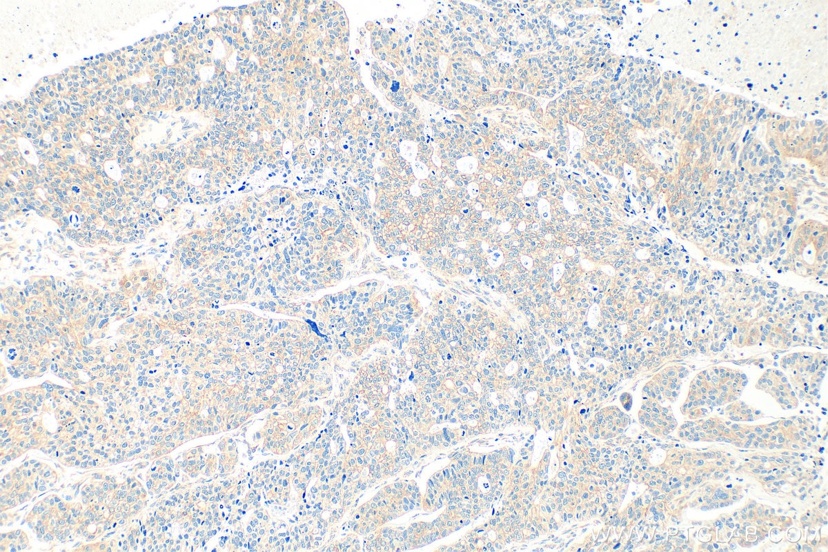 Immunohistochemistry (IHC) staining of human ovary tumor tissue using SEC62 Polyclonal antibody (28693-1-AP)