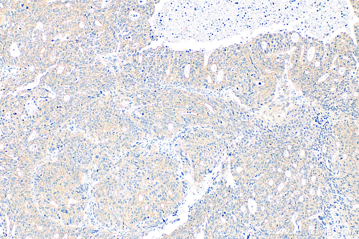Immunohistochemistry (IHC) staining of human ovary tumor tissue using SEC62 Polyclonal antibody (28693-1-AP)