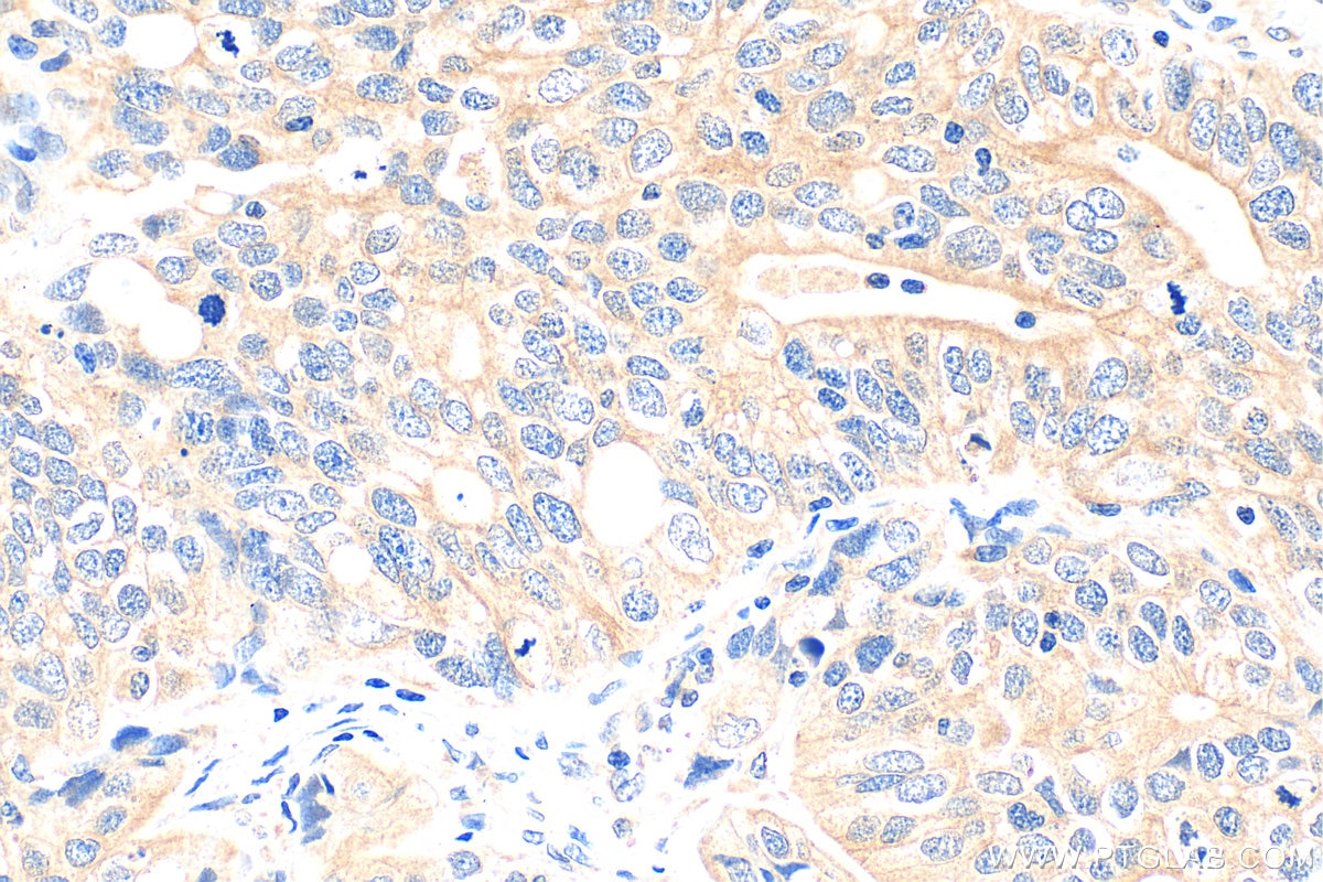 Immunohistochemistry (IHC) staining of human ovary tumor tissue using SEC62 Polyclonal antibody (28693-1-AP)