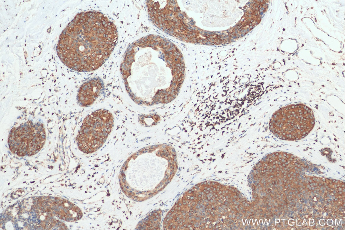 Immunohistochemistry (IHC) staining of human breast cancer tissue using SECTM1 Monoclonal antibody (60281-1-Ig)