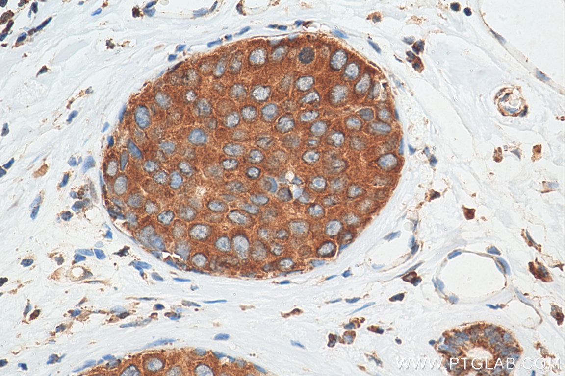 Immunohistochemistry (IHC) staining of human breast cancer tissue using SECTM1 Monoclonal antibody (60281-1-Ig)