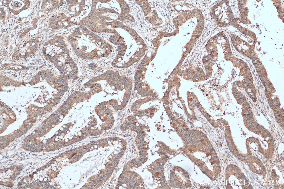 Immunohistochemistry (IHC) staining of human colon cancer tissue using SECTM1 Monoclonal antibody (60281-1-Ig)