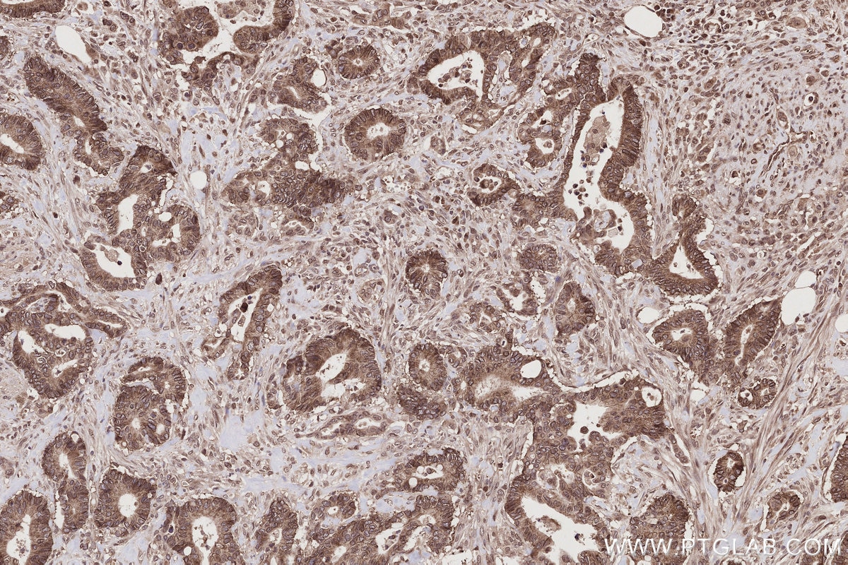 IHC staining of human rectal cancer using 15565-1-AP (same clone as 15565-1-PBS) Immunohistochemistry (IHC) staining of human rectal cancer tissue using SEH1L Polyclonal antibody (15565-1-AP)