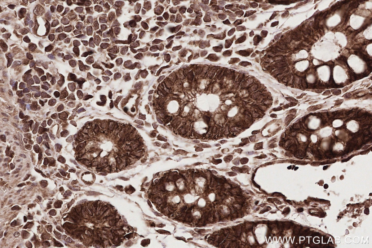 IHC staining of human rectal cancer using 15565-1-AP (same clone as 15565-1-PBS) Immunohistochemistry (IHC) staining of human rectal cancer tissue using SEH1L Polyclonal antibody (15565-1-AP)