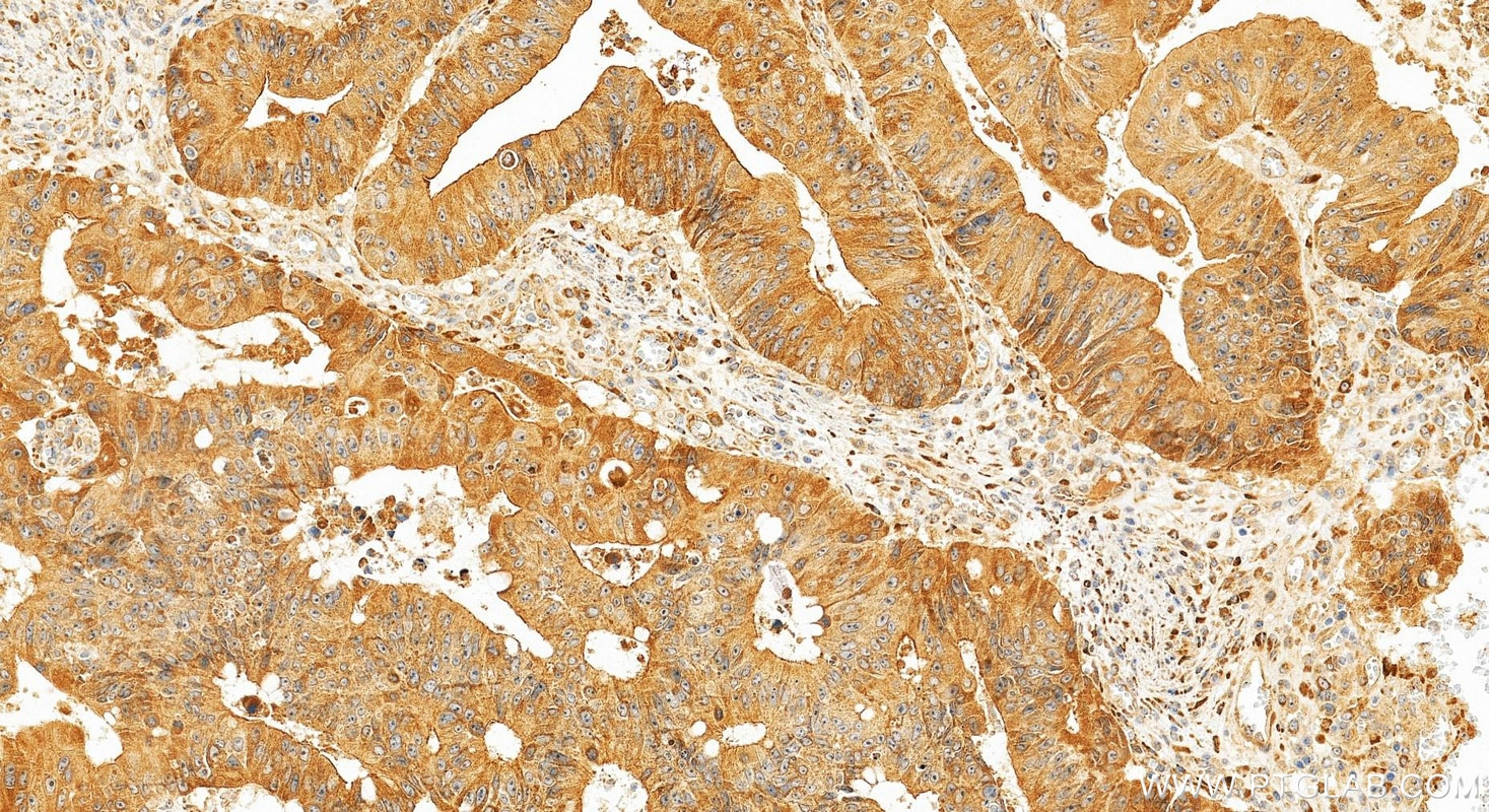 IHC staining of human colon cancer using 31489-1-AP Immunohistochemistry (IHC) staining of human colon cancer tissue using SEL1L3 Polyclonal antibody (31489-1-AP)