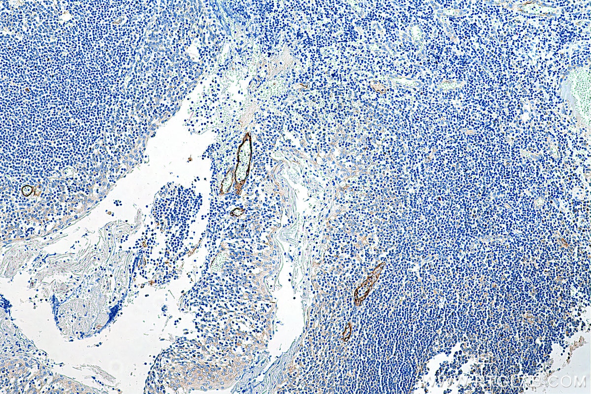 Immunohistochemistry (IHC) staining of human tonsillitis tissue using E-selectin / CD62E Polyclonal antibody (20894-1-AP)