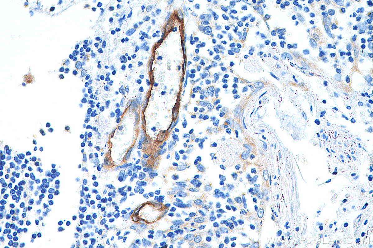 Immunohistochemistry (IHC) staining of human tonsillitis tissue using E-selectin / CD62E Polyclonal antibody (20894-1-AP)