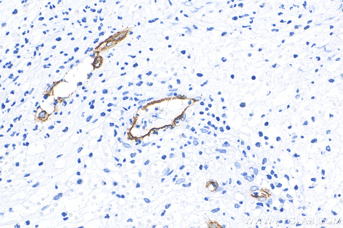 Immunohistochemistry (IHC) staining of human appendicitis tissue using E-selectin / CD62E Polyclonal antibody (20894-1-AP)
