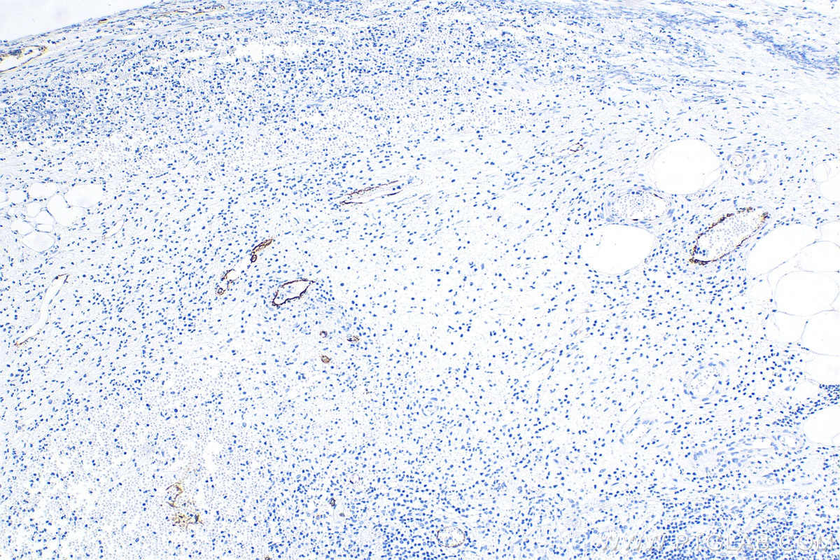 IHC staining of human appendicitis using 20894-1-AP