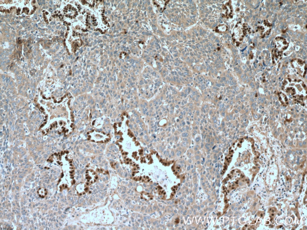 Immunohistochemistry (IHC) staining of human lung cancer tissue using SELENBP1 Polyclonal antibody (27230-1-AP)