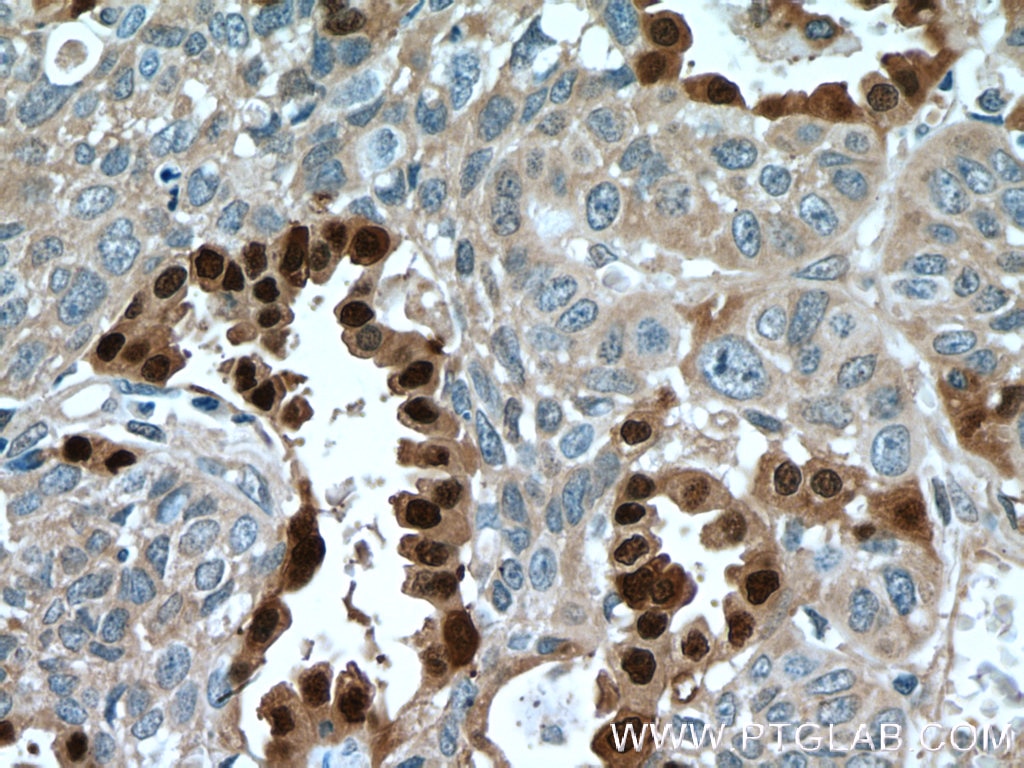 Immunohistochemistry (IHC) staining of human lung cancer tissue using SELENBP1 Polyclonal antibody (27230-1-AP)